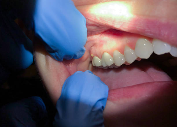 Best Emergency Dentist for Lost Fillings or Crowns in Connersville, IN